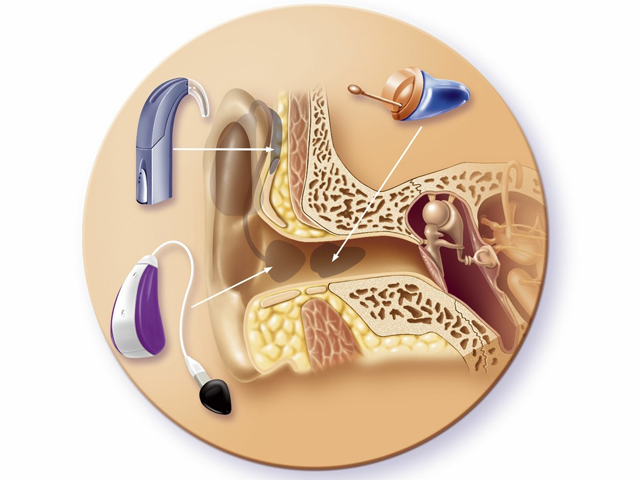 助听器是越隐形越昂贵吗?
