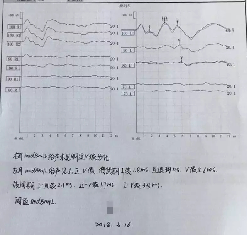 感音神经性耳聋